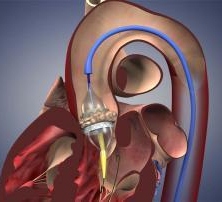 Baptist hospital promotes new heart valve treatment
