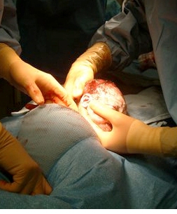 C-Sections may drive obesity epidemic