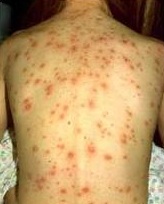 Keep kids with chickenpox home, public health asks